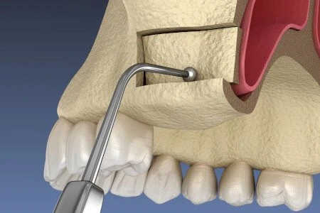 Sinus Liftinq Proseduru