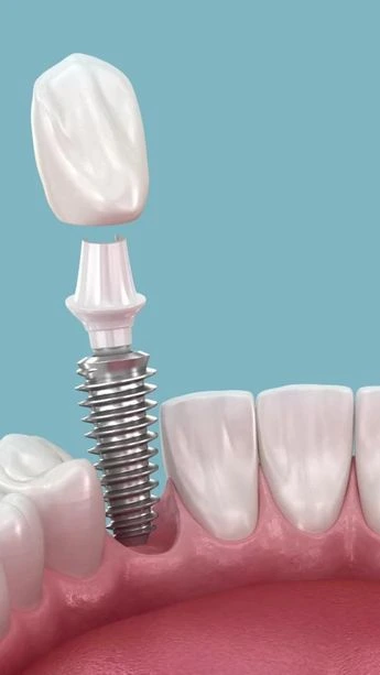 Implantology Image 2