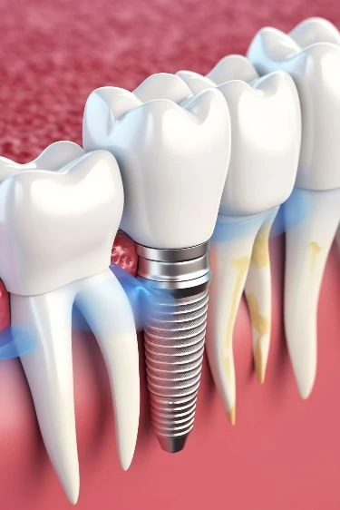 Implantology Image 1