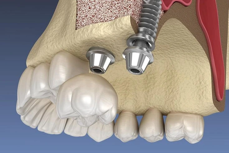 Sinus Liftinq Cərrahiyyəsi